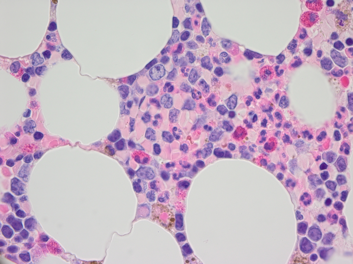 Bone marrow core biopsy from recurrent marrow